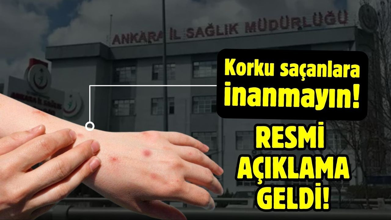 Ankara İl Sağlık Müdürlüğünden M çiçeği açıklaması